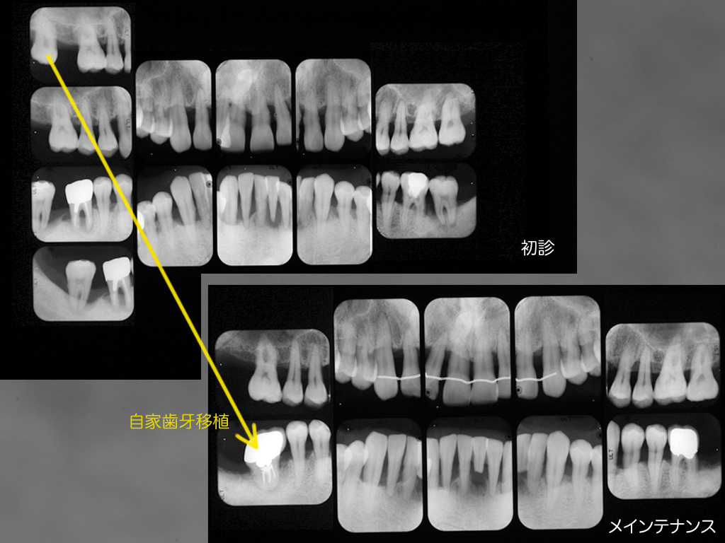 http://www.makino418.com/blog/2014/06/15/Perio%E3%81%A8%E7%A7%BB%E6%A4%8D.jpg