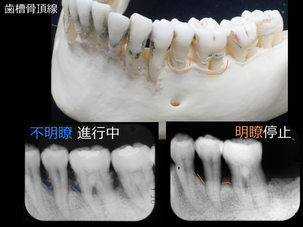 http://www.makino418.com/blog/2017/06/14/%E6%AD%AF%E6%A7%BD%E9%AA%A8%E9%A0%82%E7%B7%9A%E6%98%8E%E7%9E%AD%E4%B8%8D%E6%98%8E%E7%9E%AD.jpg