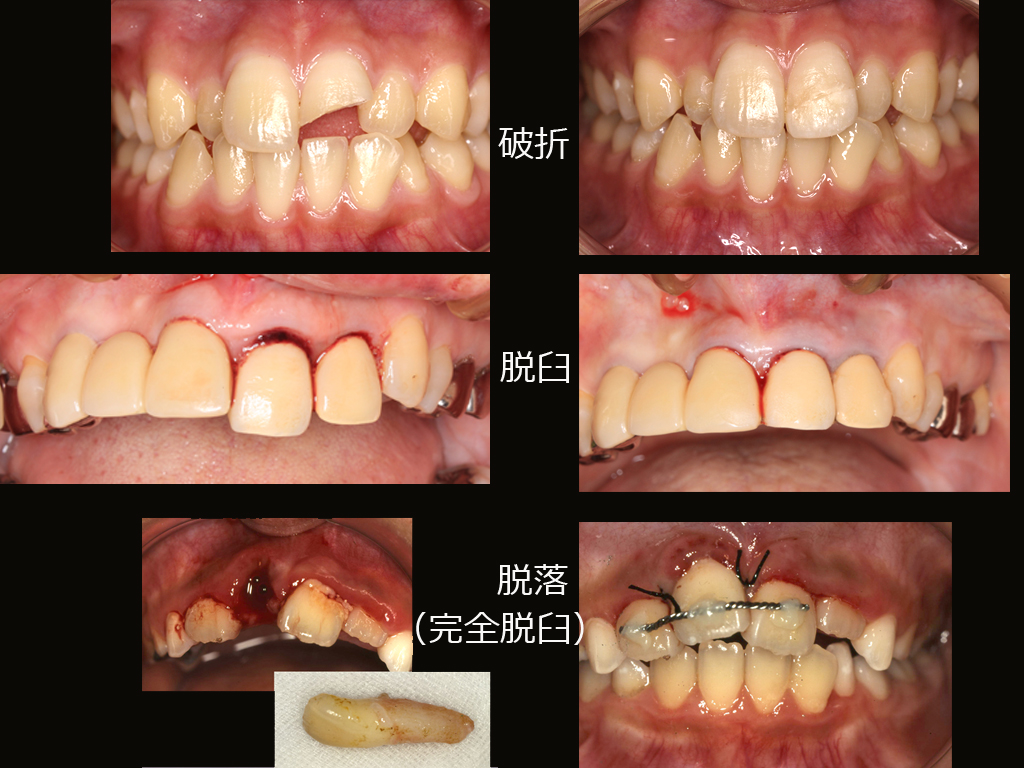 http://www.makino418.com/blog/2018/04/07/%E6%AD%AF%E3%81%AE%E5%A4%96%E5%82%B7.jpg