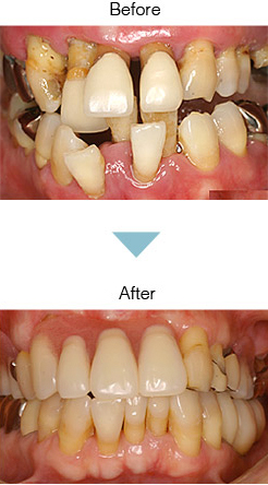 歯周病治療・メインテナンス Before After