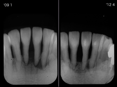 X線像アーカイブ 院長ブログ - まきの歯科医院 | 富山県高岡市