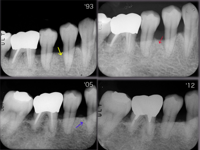 X線像アーカイブ 院長ブログ - まきの歯科医院 | 富山県高岡市