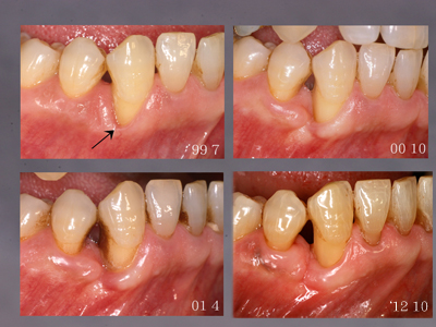 付着歯肉増大.jpg