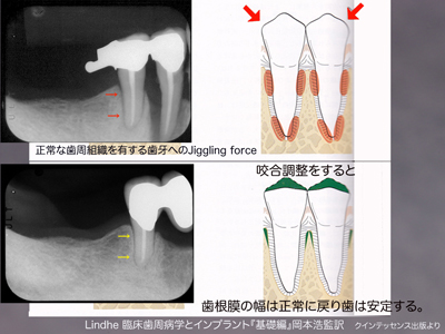 歯根膜腔の拡大 院長ブログ - まきの歯科医院 | 富山県高岡市