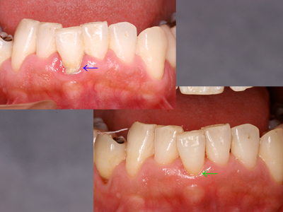 歯石と歯肉退縮小.jpg