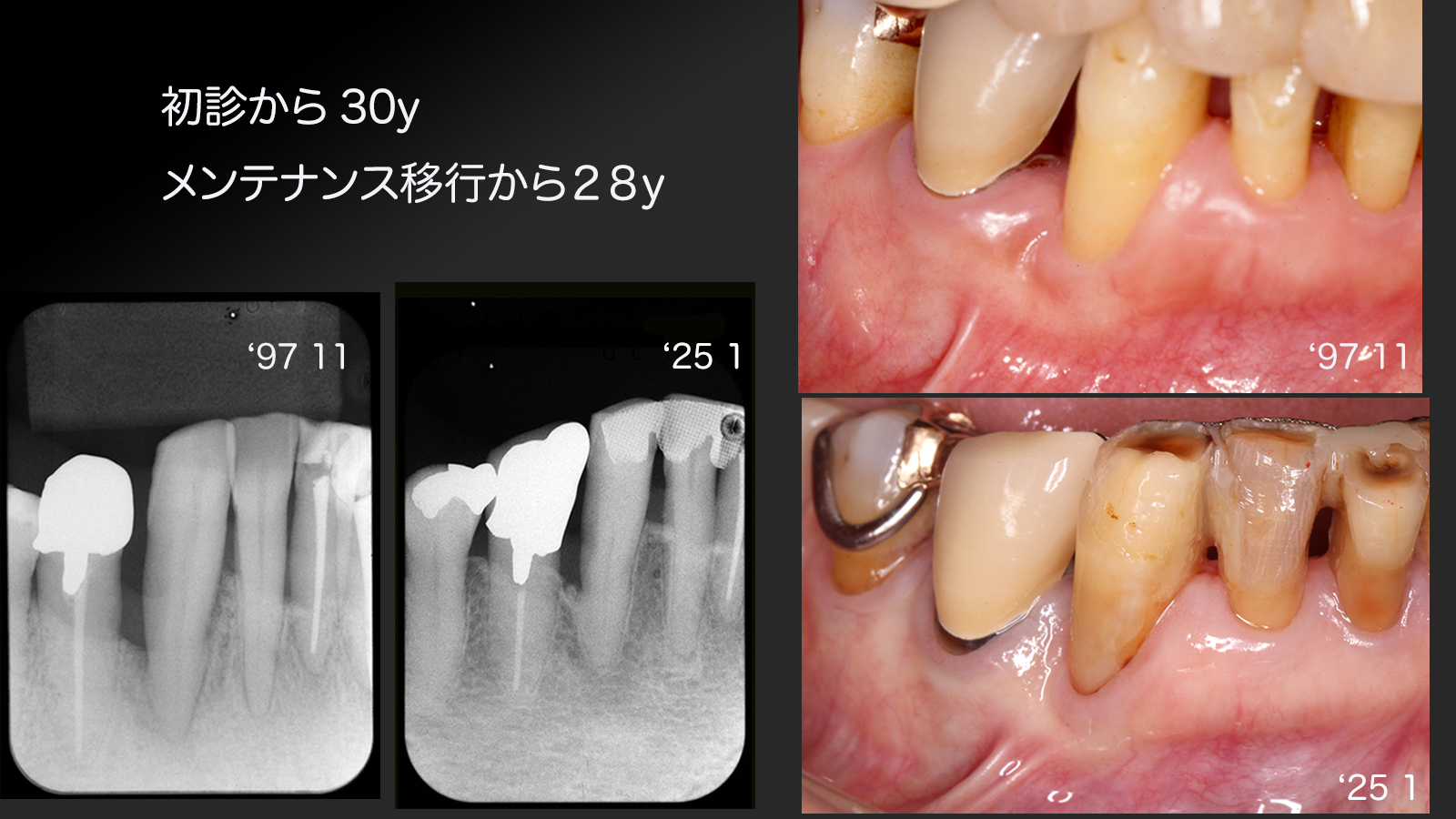 https://www.makino418.com/blog/2025/02/10/%E5%88%9D%E8%A8%BA%E3%81%8B%E3%82%8930y.jpg