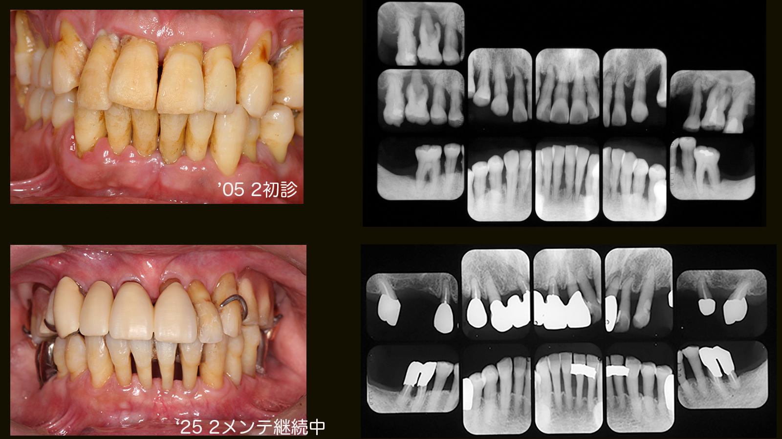 https://www.makino418.com/blog/2025/02/18/%E3%83%A1%E3%83%B3%E3%83%8620%E5%B9%B4.jpg