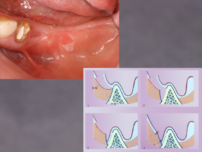 歯槽堤形成術 Edran-Mejcher法（二次上皮化法） 院長ブログ - まきの