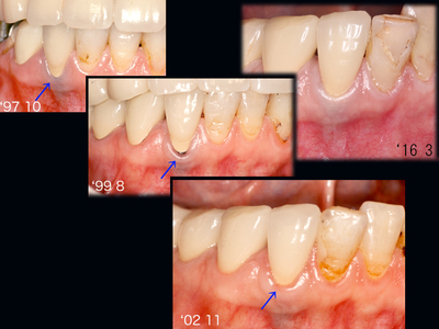 歯肉退縮〜クリーピング２.jpg
