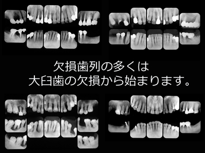 欠損歯列の多くは〜.jpg