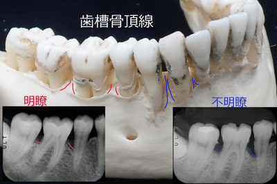 歯槽骨頂線.jpg