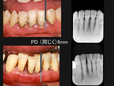 歯肉炎と歯周炎2.jpg