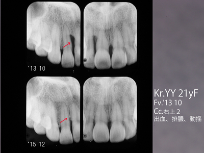 歯周組織再生療法Xーp１.jpgのサムネール画像