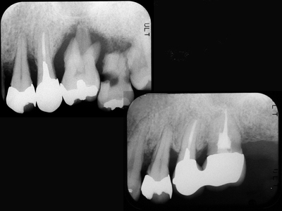 歯周組織再生３.jpg