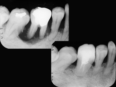 歯根膜による歯周組織再生〜.jpg
