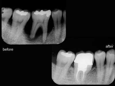 歯根膜による２.jpg