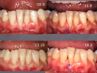 歯肉退縮〜クリーピング.jpg