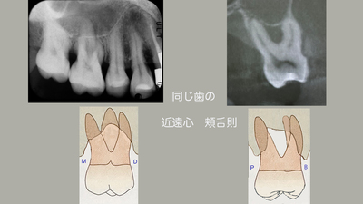 根分岐部のB~Ppsd.jpg