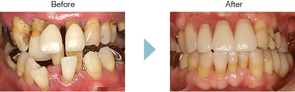 歯周病治療・メインテナンス Before After