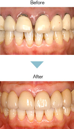 審美修復 Before After