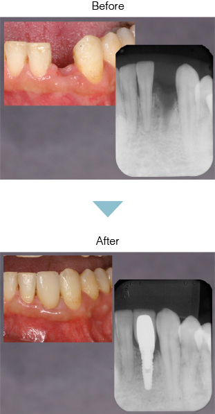 インプラント Before After