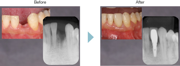 インプラント Before After