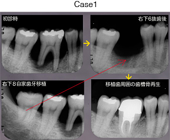 自家歯牙移植 Before