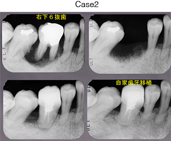 自家歯牙移植 After