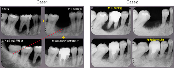 自家歯牙移植 Before After