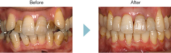 PMTC Before After