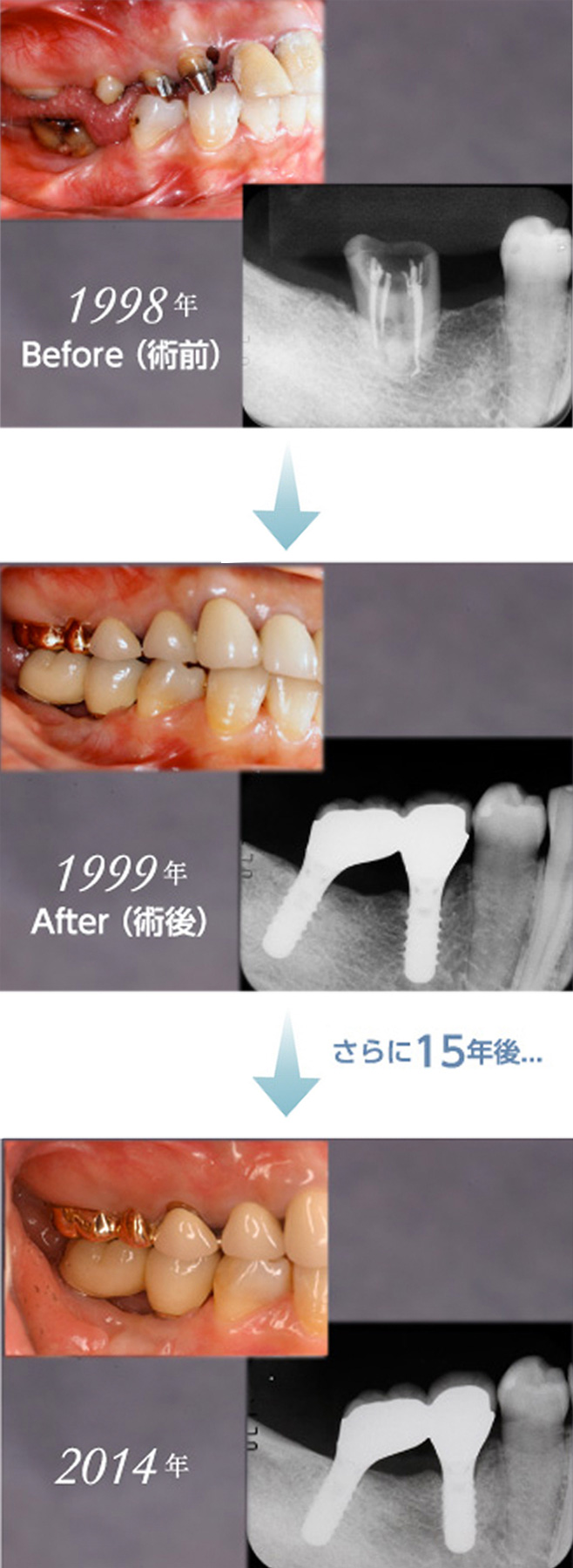 16年前にインプラント治療し、今でもまったく遜色なく、きれいな状態