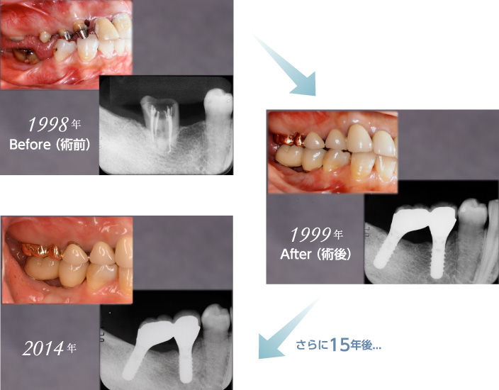 16年前にインプラント治療し、今でもまったく遜色なく、きれいな状態